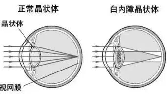 白内障.jpg