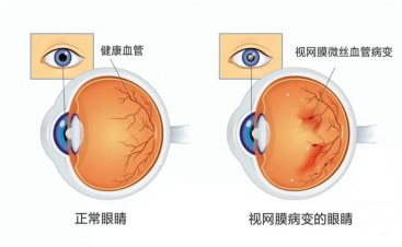 正常与糖网对比.png