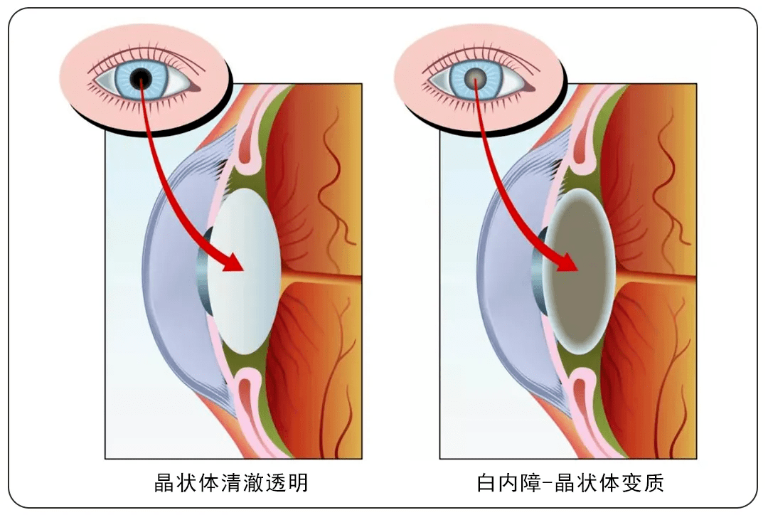 白内障.png