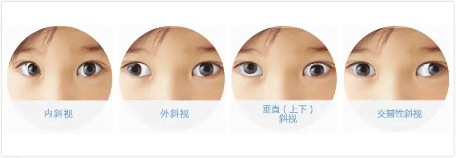 斜弱视.jpg