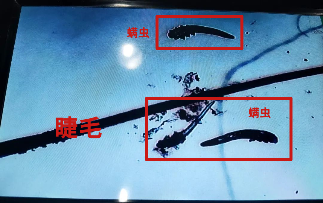 螨虫检查.png